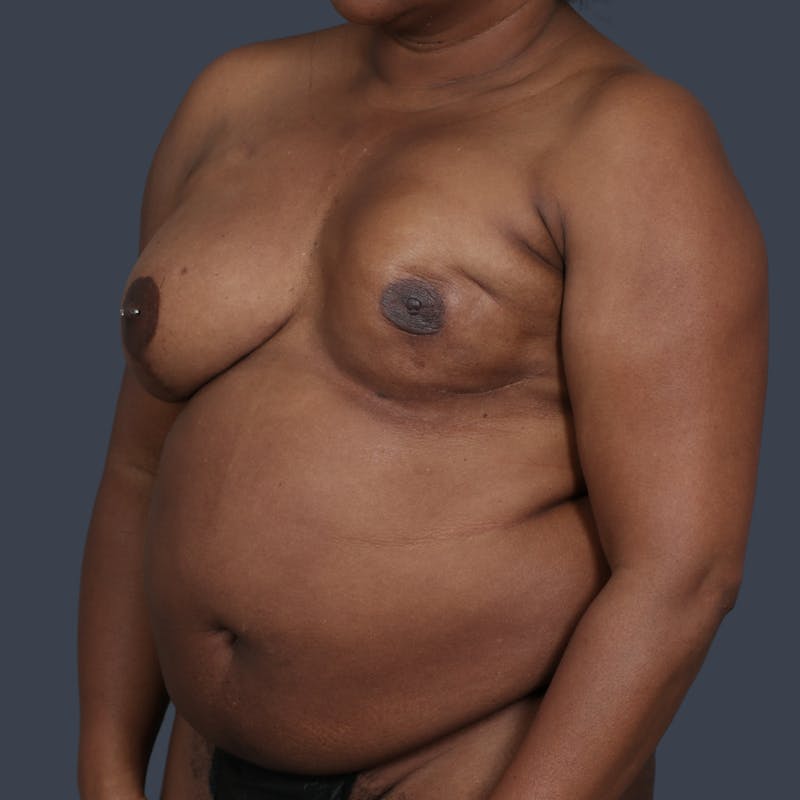 DIEP Flap Before & After Gallery - Patient 308687 - Image 5