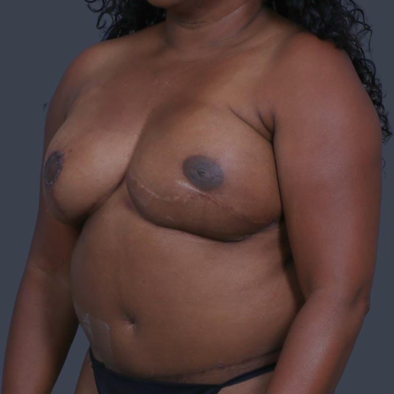 DIEP Flap Before & After Gallery - Patient 308687 - Image 6