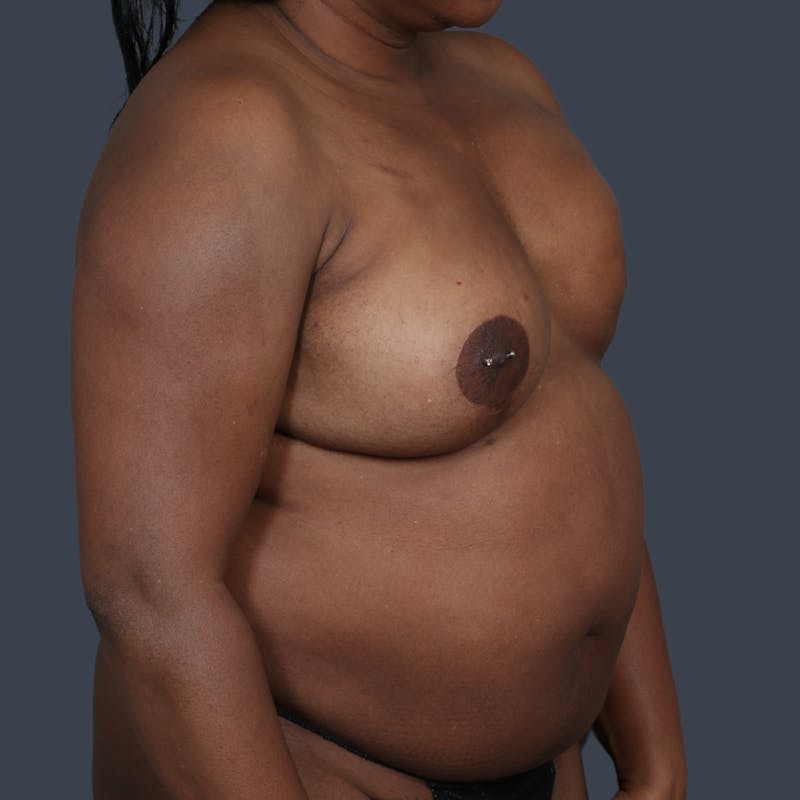 DIEP Flap Before & After Gallery - Patient 308687 - Image 3