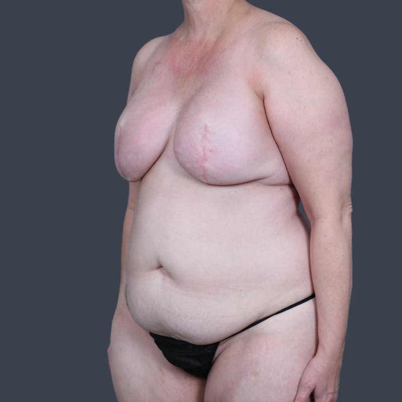 DIEP Flap Before & After Gallery - Patient 154176 - Image 6