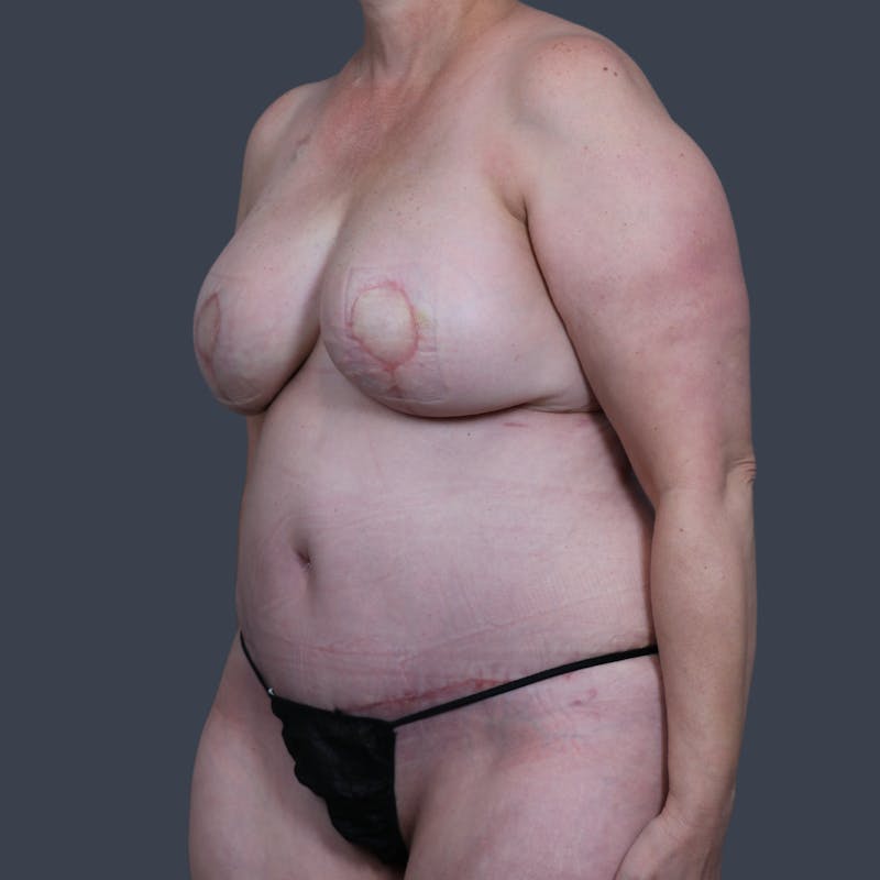 DIEP Flap Before & After Gallery - Patient 154176 - Image 8