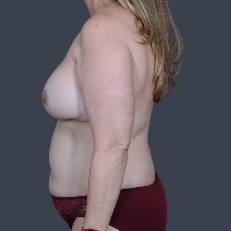 DIEP Flap Before & After Gallery - Patient 154176 - Image 9