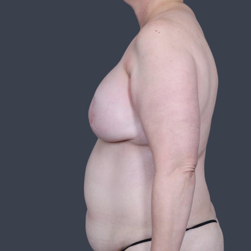 DIEP Flap Before & After Gallery - Patient 154176 - Image 10