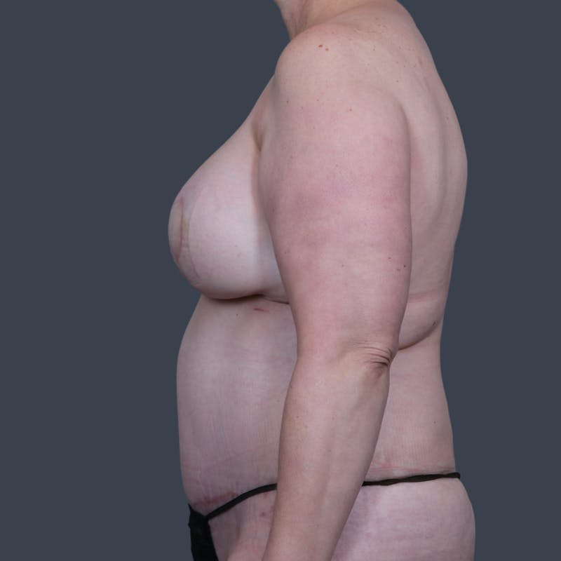 DIEP Flap Before & After Gallery - Patient 154176 - Image 12