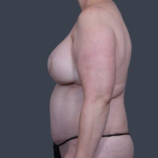 DIEP Flap Before & After Gallery - Patient 154176 - Image 12