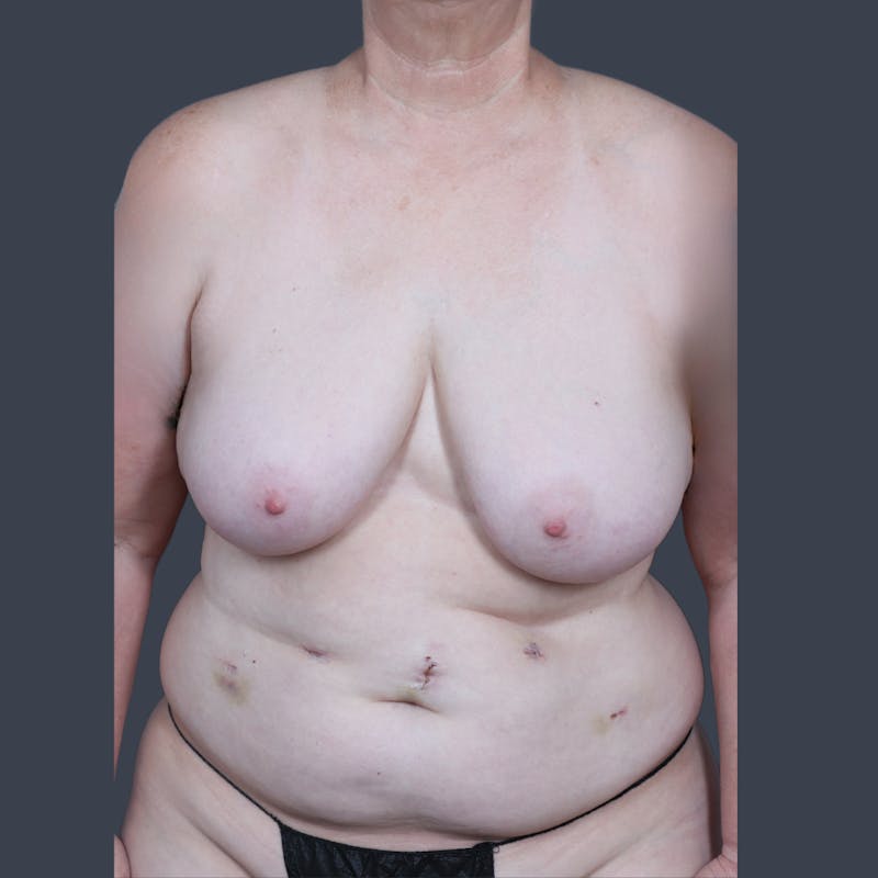 DIEP Flap Before & After Gallery - Patient 249595 - Image 1