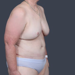 DIEP Flap Before & After Gallery - Patient 249595 - Image 4