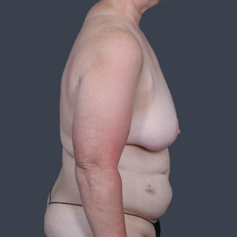 DIEP Flap Before & After Gallery - Patient 249595 - Image 5
