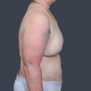 DIEP Flap Before & After Gallery - Patient 249595 - Image 6