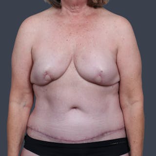 DIEP Flap Before & After Gallery - Patient 170862 - Image 2