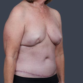 DIEP Flap Before & After Gallery - Patient 170862 - Image 6
