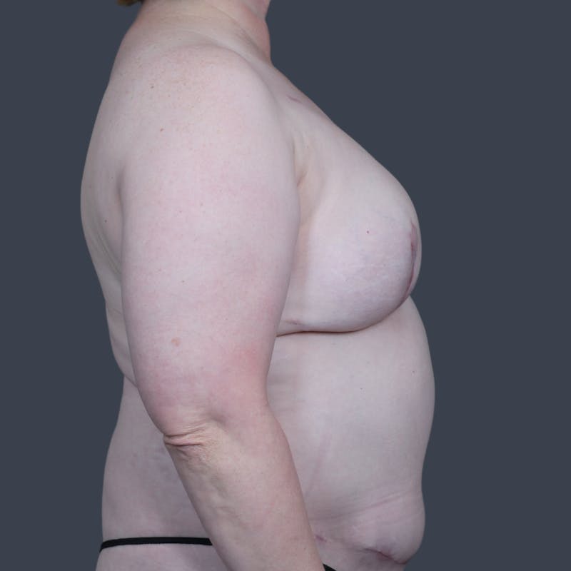 DIEP Flap Before & After Gallery - Patient 363650 - Image 6