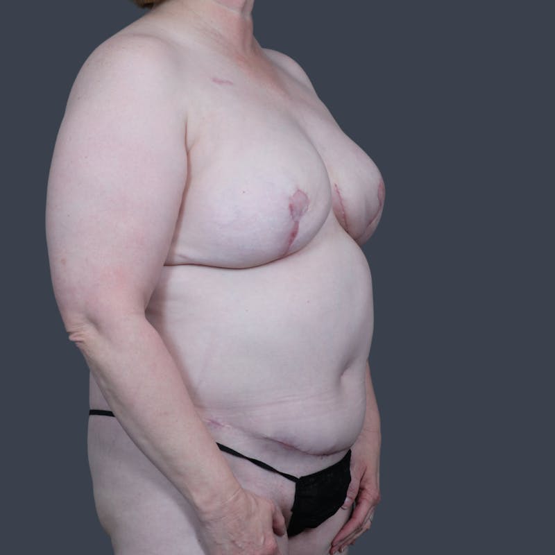 DIEP Flap Before & After Gallery - Patient 363650 - Image 4