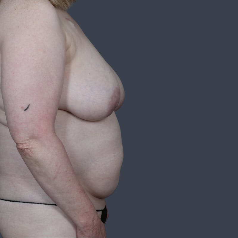 DIEP Flap Before & After Gallery - Patient 363650 - Image 5