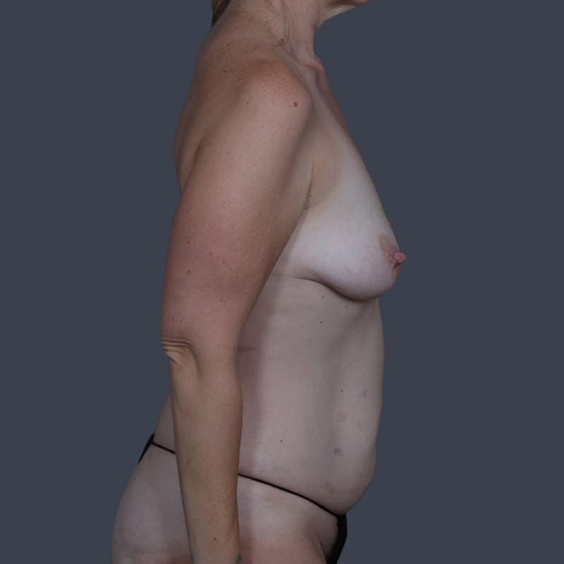 DIEP Flap Before & After Gallery - Patient 408247 - Image 5