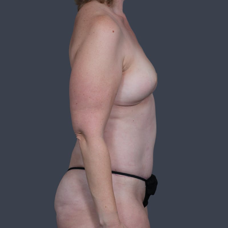 DIEP Flap Before & After Gallery - Patient 408247 - Image 6