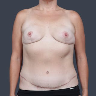 DIEP Flap Before & After Gallery - Patient 680772 - Image 2