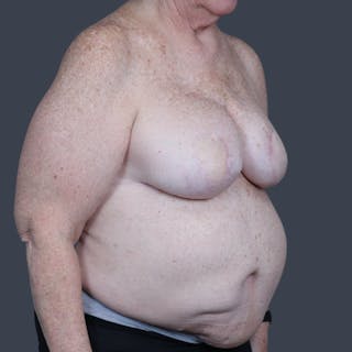 DIEP Flap Before & After Gallery - Patient 204040 - Image 4