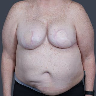 DIEP Flap Before & After Gallery - Patient 204040 - Image 2