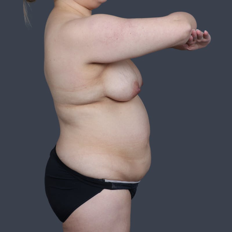 Abdominoplasty / Tummy Tuck Before & After Gallery - Patient 341521 - Image 5