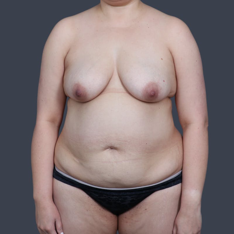 Abdominoplasty / Tummy Tuck Before & After Gallery - Patient 341521 - Image 1