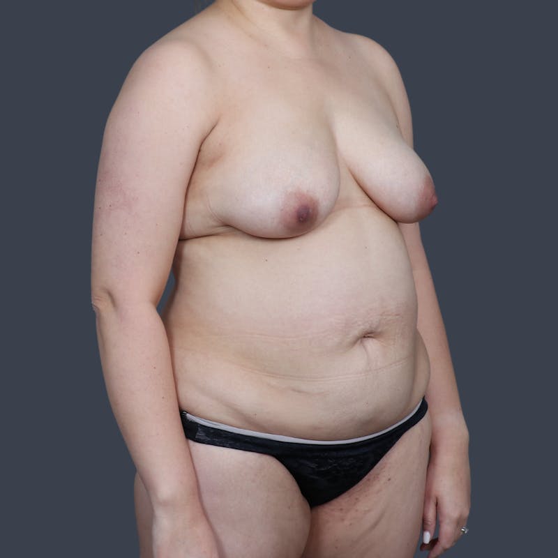 Abdominoplasty / Tummy Tuck Before & After Gallery - Patient 341521 - Image 3