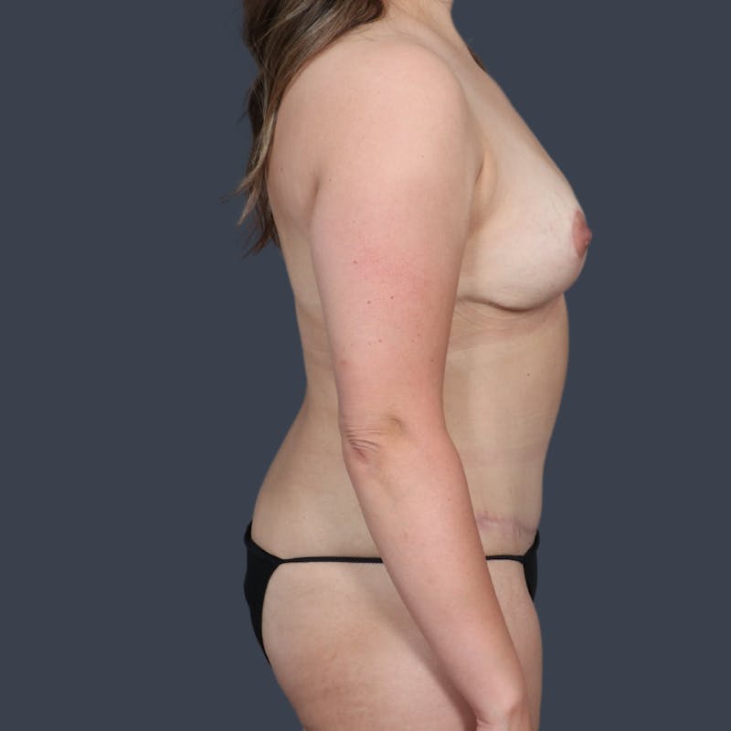 Abdominoplasty / Tummy Tuck Before & After Gallery - Patient 341521 - Image 6