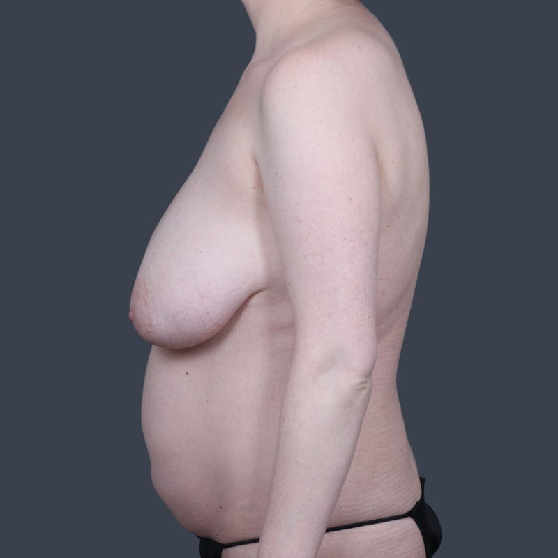 Abdominoplasty / Tummy Tuck Before & After Gallery - Patient 387408 - Image 5