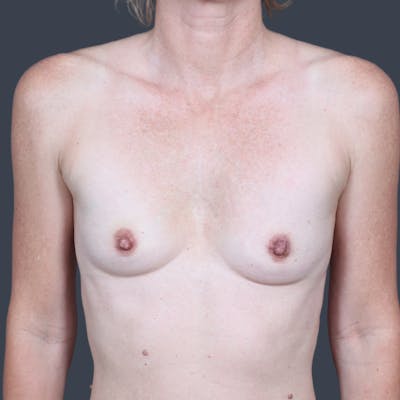Breast Augmentation Before & After Gallery - Patient 317713 - Image 1