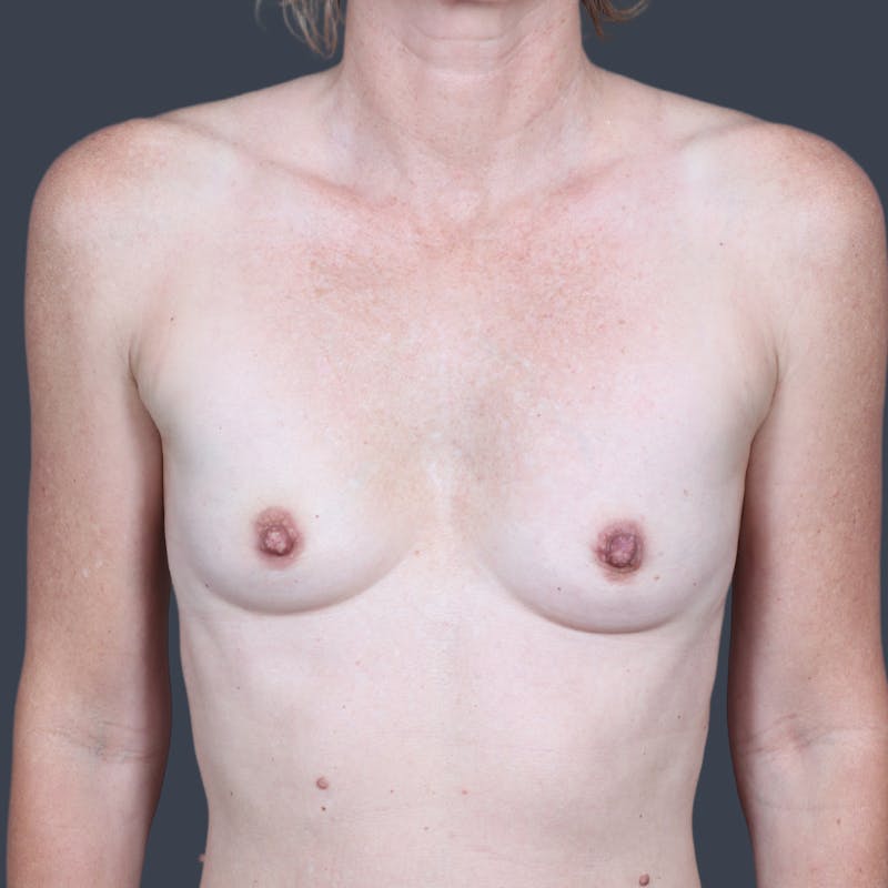 Breast Augmentation Before & After Gallery - Patient 317713 - Image 1