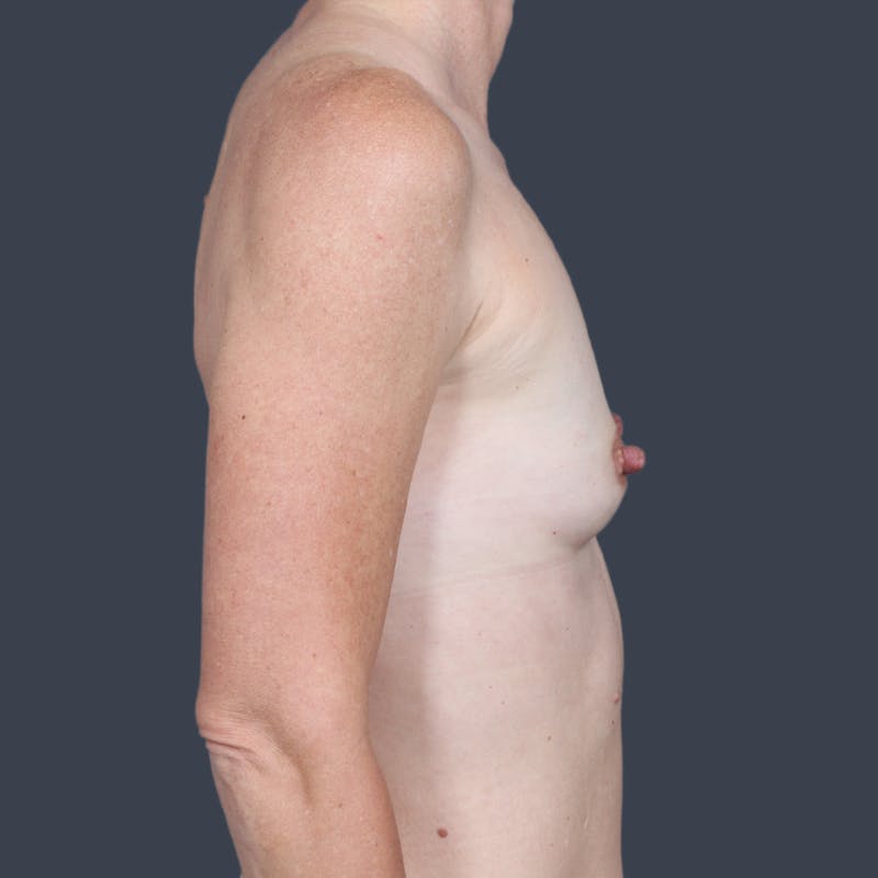 Breast Augmentation Before & After Gallery - Patient 317713 - Image 5
