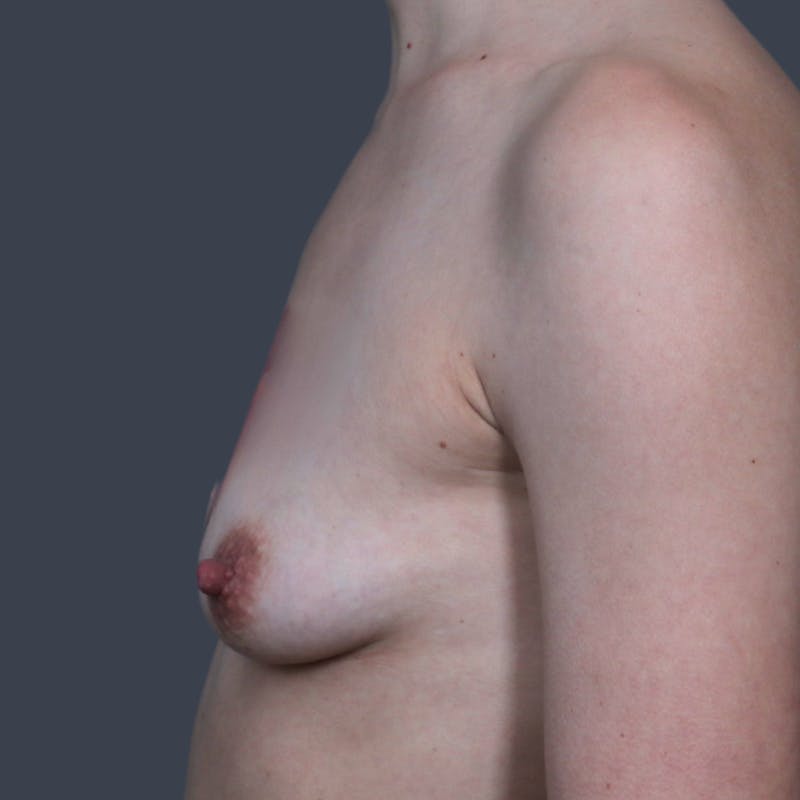 Breast Augmentation Before & After Gallery - Patient 137112 - Image 5