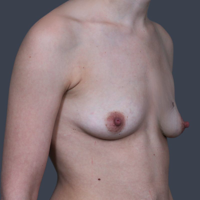 Breast Augmentation Before & After Gallery - Patient 329186 - Image 3