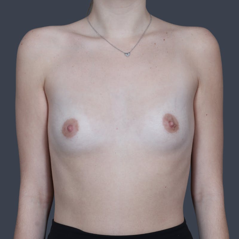 Breast Augmentation Before & After Gallery - Patient 115731 - Image 1