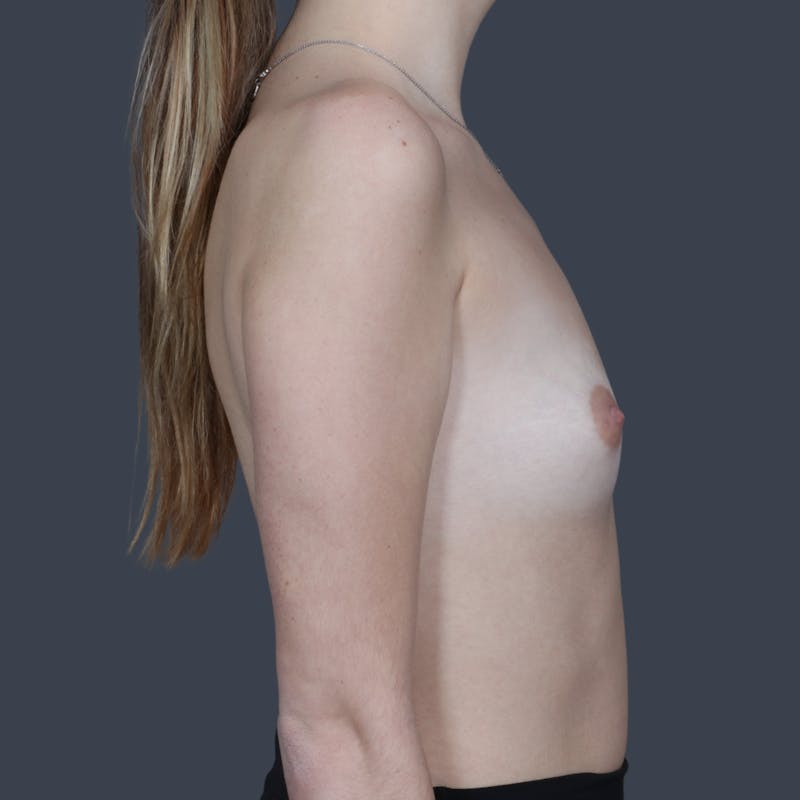Breast Augmentation Before & After Gallery - Patient 115731 - Image 5