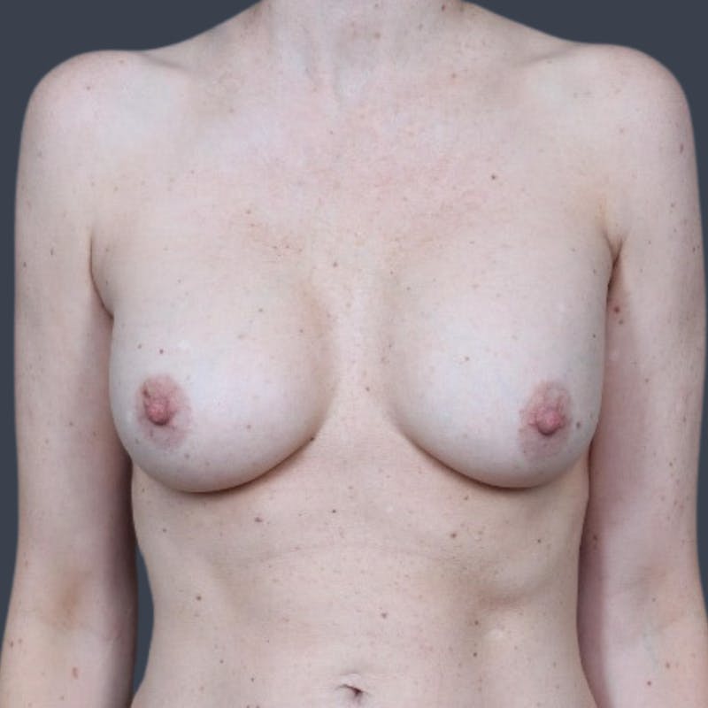 Implant Exchange Before & After Gallery - Patient 366331 - Image 1