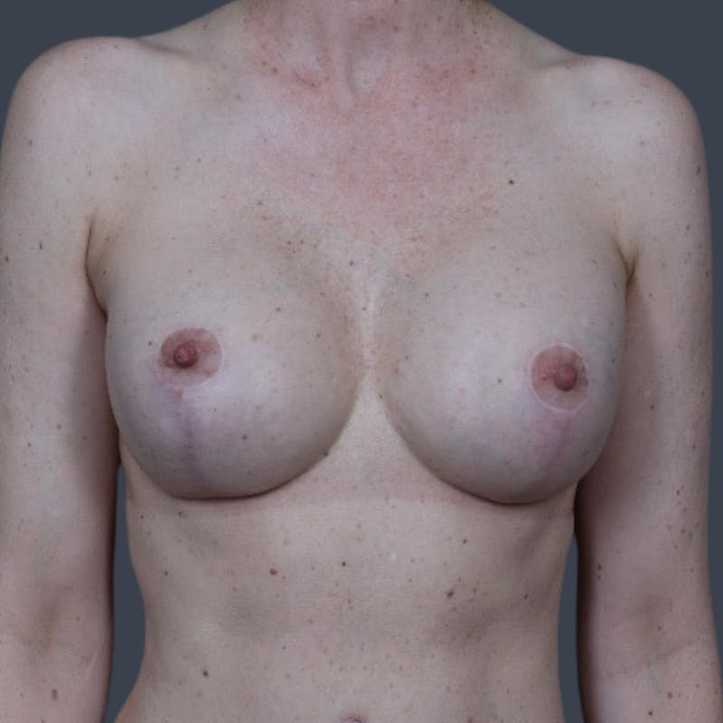 Implant Exchange Before & After Gallery - Patient 366331 - Image 2