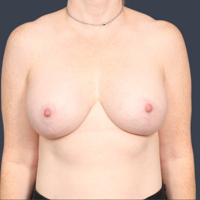Implant Exchange Before & After Gallery - Patient 314564 - Image 2
