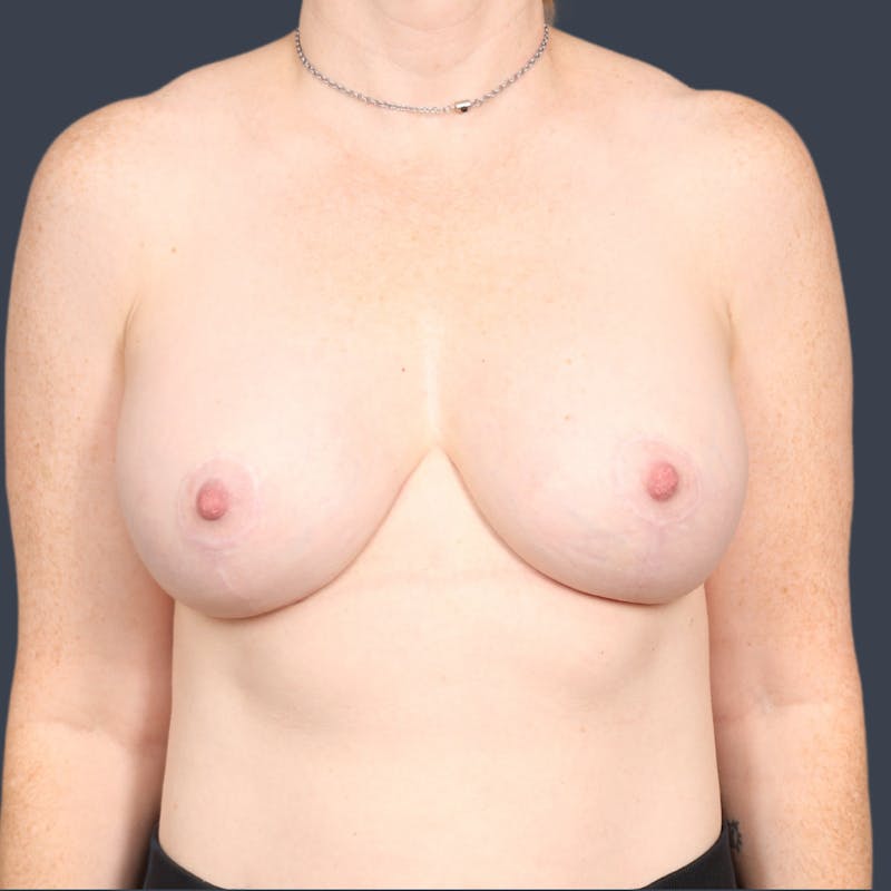Implant Exchange Before & After Gallery - Patient 314564 - Image 2