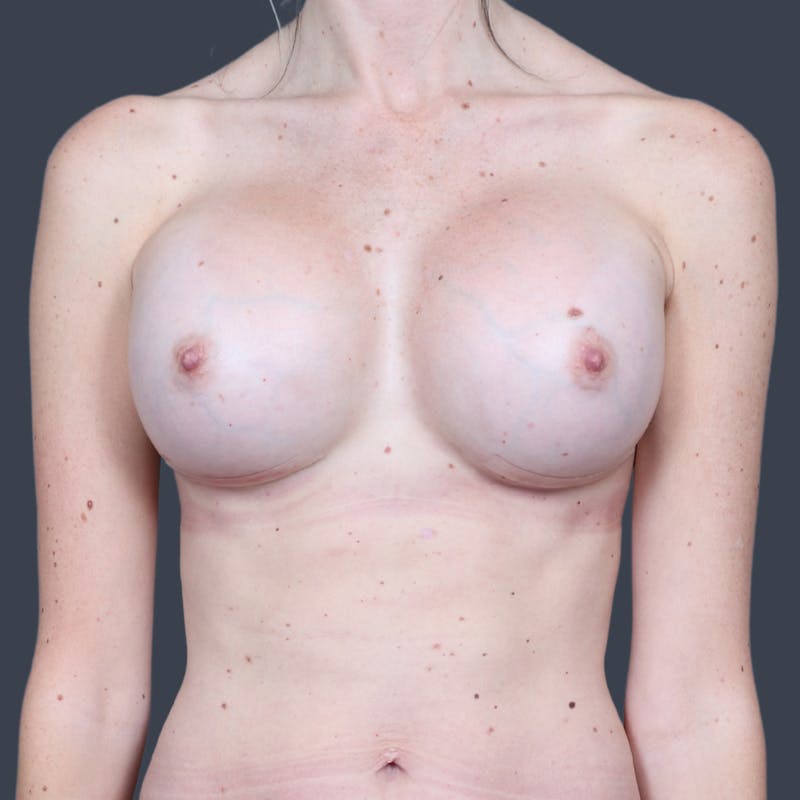 Implant Exchange Before & After Gallery - Patient 370975 - Image 2
