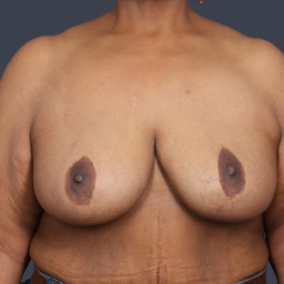 Implant Removal Before & After Gallery - Patient 416225 - Image 2