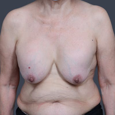 Implant Removal Before & After Gallery - Patient 346169 - Image 1