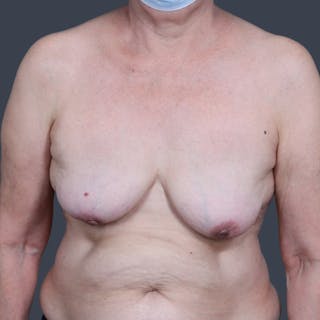 Implant Removal Before & After Gallery - Patient 346169 - Image 2