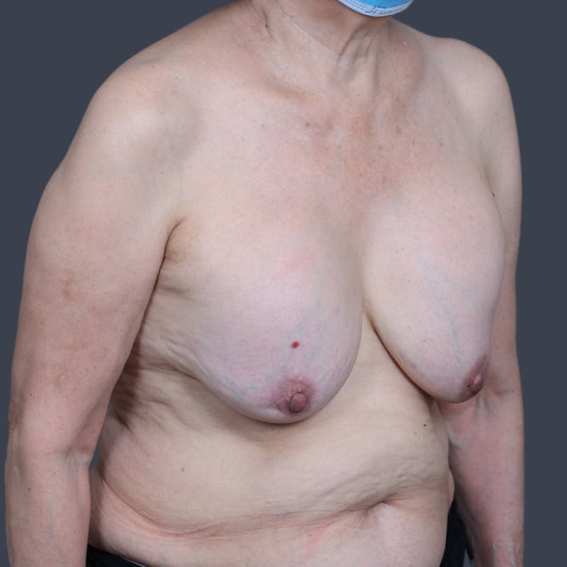 Implant Removal Before & After Gallery - Patient 346169 - Image 3
