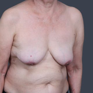 Implant Removal Before & After Gallery - Patient 346169 - Image 4