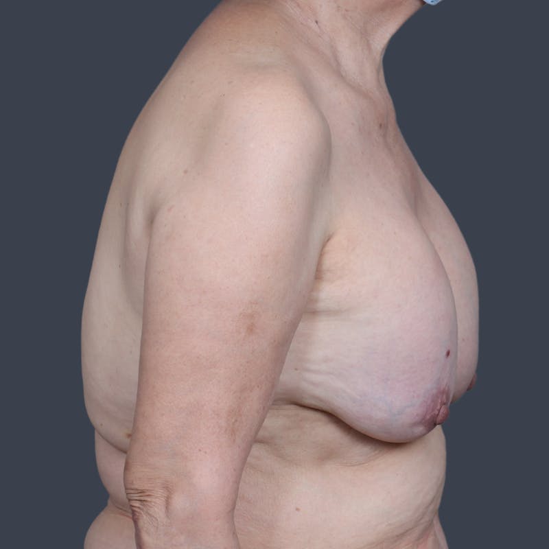 Implant Removal Before & After Gallery - Patient 346169 - Image 5