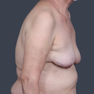 Implant Removal Before & After Gallery - Patient 346169 - Image 6