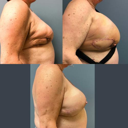After procedure image for Oncoplastic/Lumpectomy Reconstruction