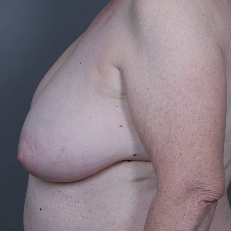 Oncoplastic Breast Reconstruction Before & After Gallery - Patient 230019 - Image 5