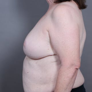 Oncoplastic Breast Reconstruction Before & After Gallery - Patient 230019 - Image 6